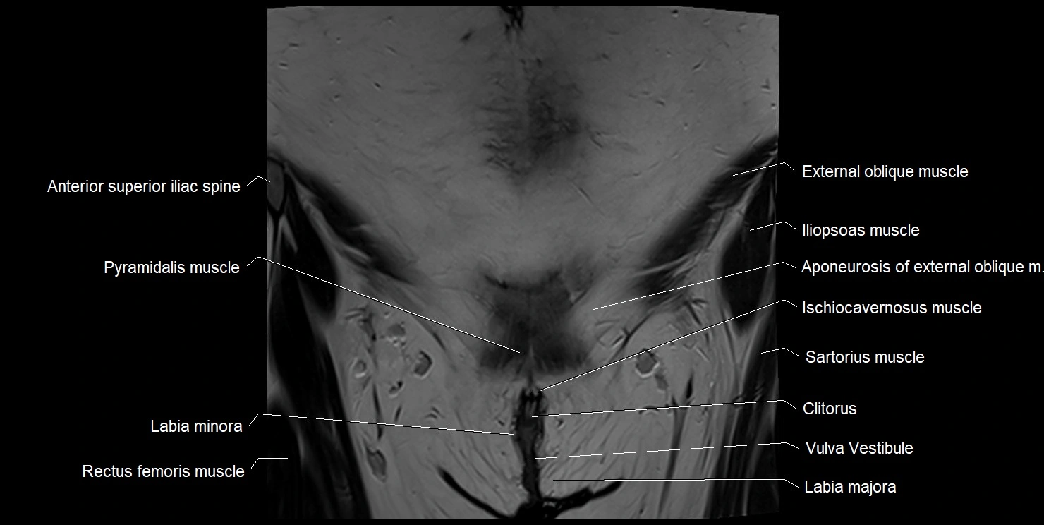 female pelvis coronal cross sectional anatomy image 4.webp